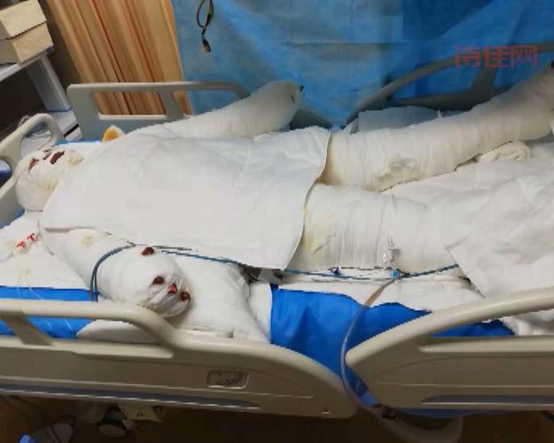 父亲割皮救女真感人！伟大父爱让人泪目