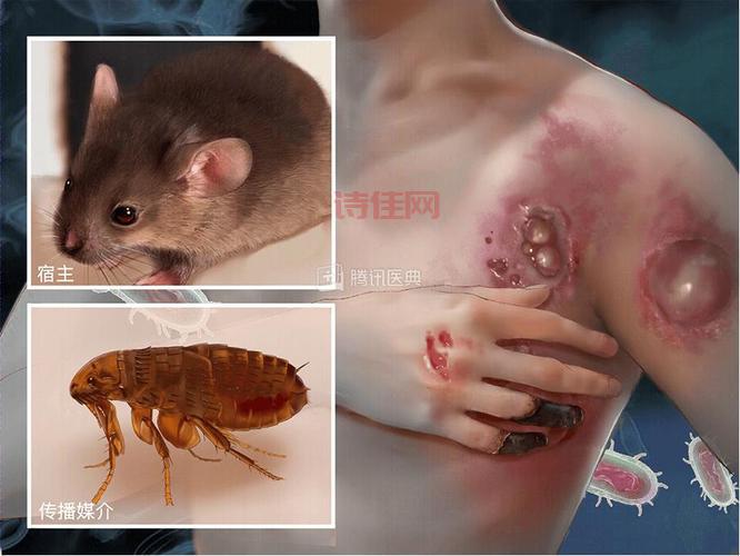 突发！北京确认接诊鼠疫病例，会传染吗？