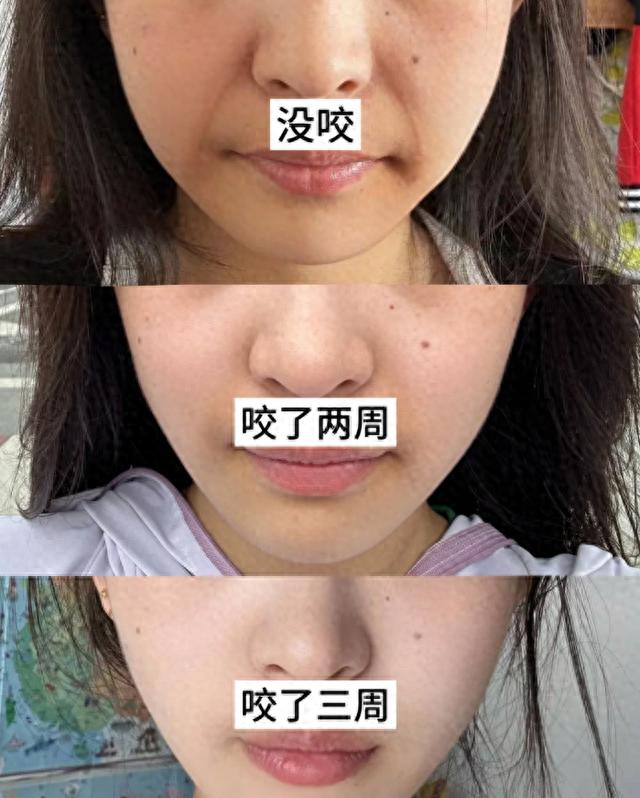 古法咬筷子 + 咬瓶子！有法令纹的快试 我现在都快忘了法令纹啥样