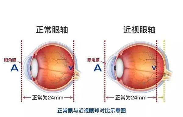抢！近视手术0元摘镜，免费术前检查等你来领