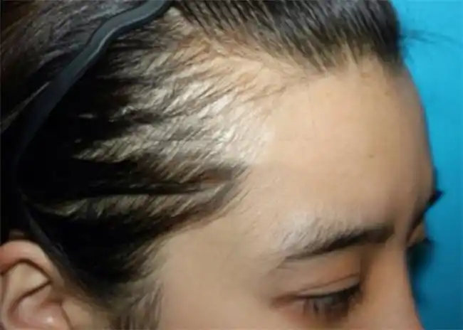 发际线后移与这些日常习惯有关，发教授低敏型米诺地尔来拯救