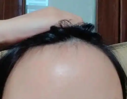 担心遗传导致发际线后移？发教授温和生发守护你的前额防线
