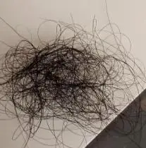 担心遗传导致发际线后移？发教授温和生发守护你的前额防线