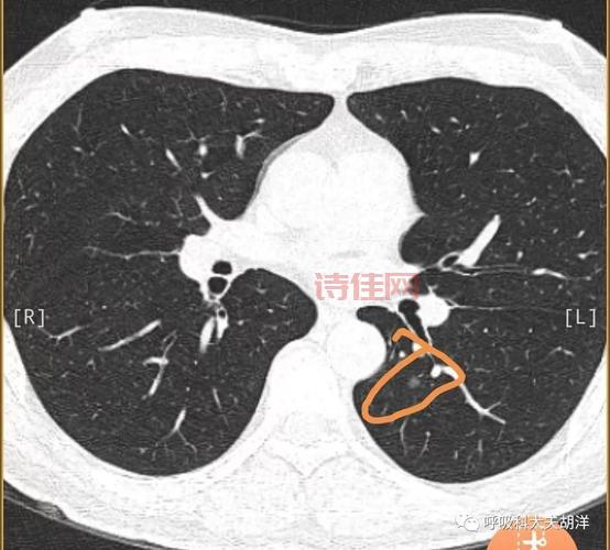 常熟银行肺部结节要紧吗？听听专家怎么说！