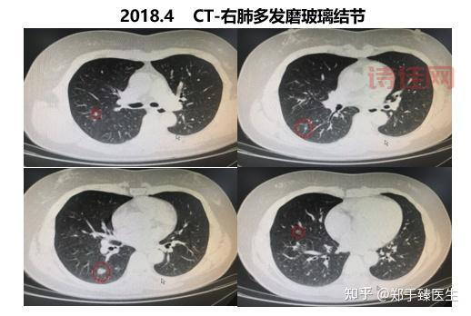 常熟银行肺部结节要紧吗？听听专家怎么说！