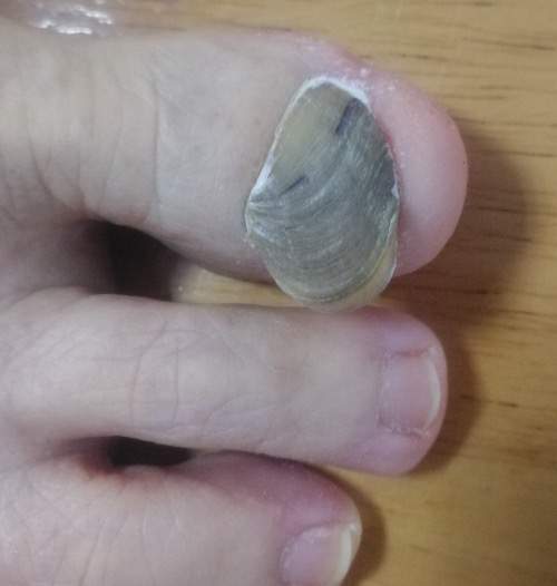 脚趾上长了个“牡蛎”？每走一步，都像被人用钳子狠狠地夹了一下
