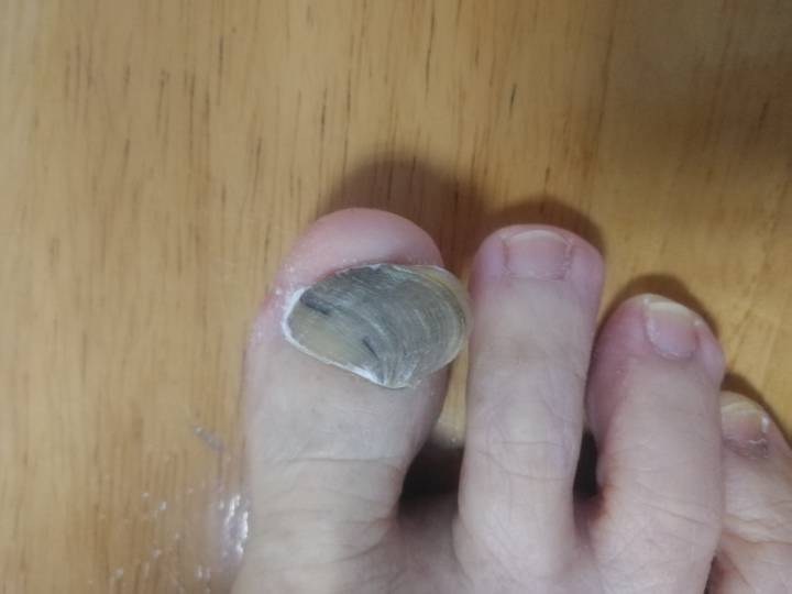 脚趾上长了个“牡蛎”？每走一步，都像被人用钳子狠狠地夹了一下