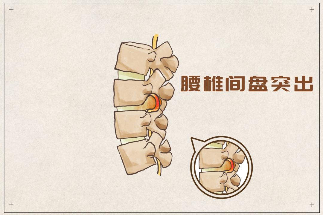 腰椎间盘突出与腰椎间盘突出症，别再傻傻分不清！