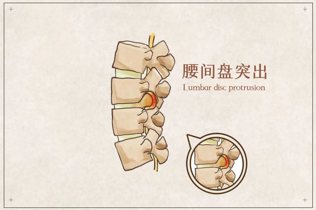 都是腰椎间盘，为啥就我的那么“突出”？