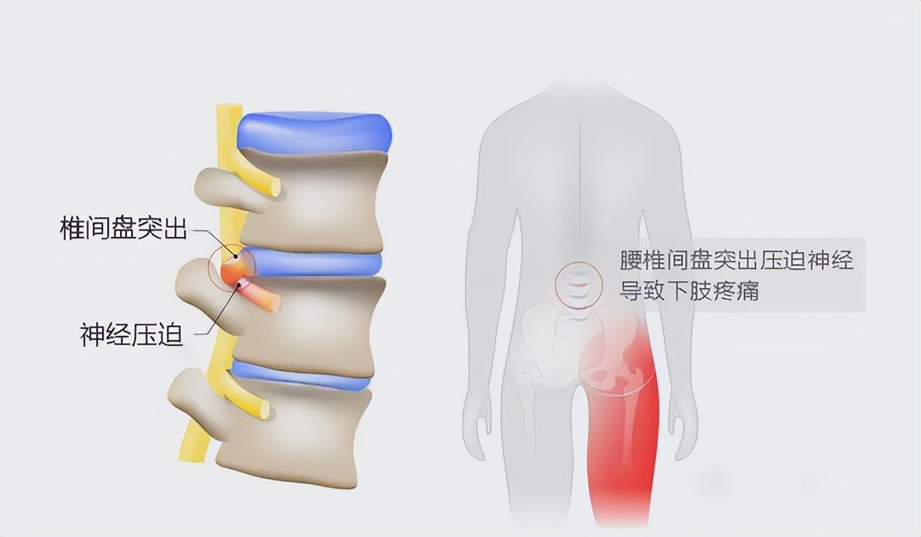 腰椎滑脱和腰椎间盘突出一样么？您知道怎么区分它们吗？