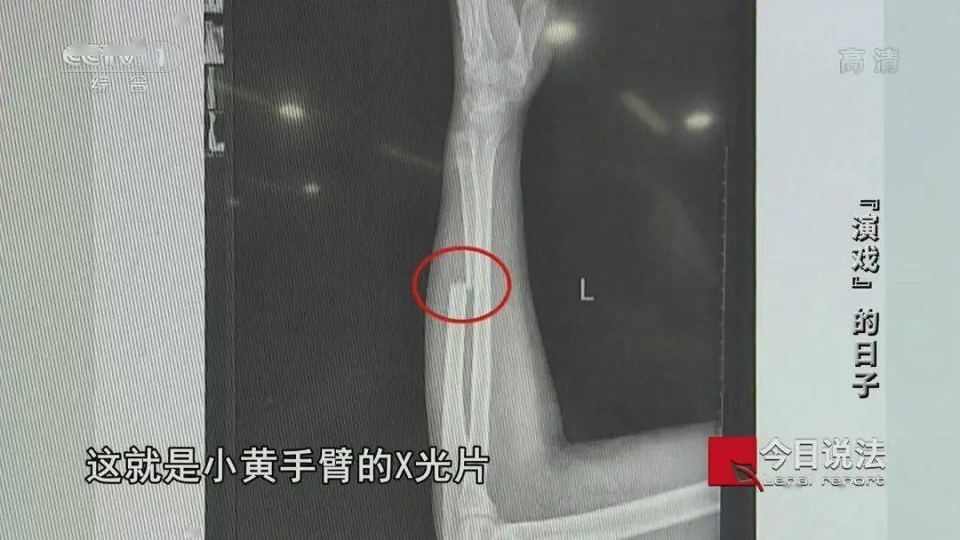 把你手打断，还要你帮忙碰瓷！碰瓷诈骗的底线你想不到！