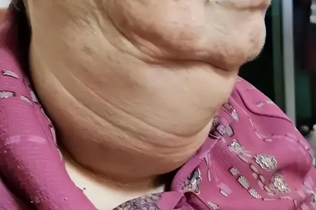 小便是肿瘤最好的反馈!当小便出现这三种异常，多半是体内有肿瘤