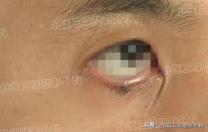 睫毛根部长了个痣怎么弄?