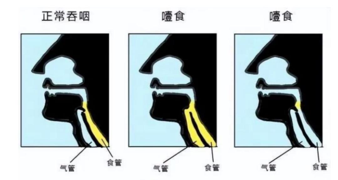 医声丨中国医大说科普——噎食？气道阻塞？食物窒息？