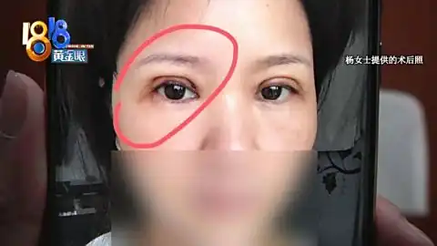 双眼皮手术以后，左眼成了“三角形”？