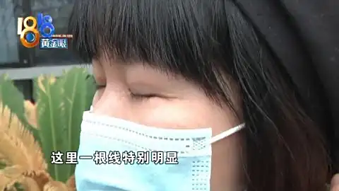 双眼皮手术以后，左眼成了“三角形”？