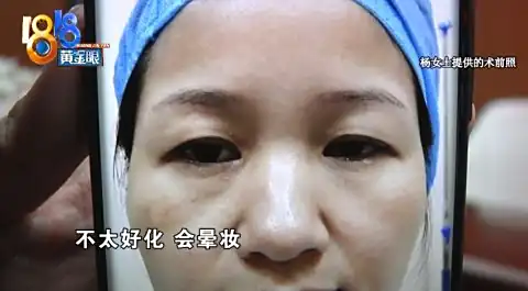 双眼皮手术以后，左眼成了“三角形”？