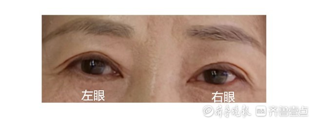 壹点帮办|双眼皮整形整成了“三角眼”？俏嘉丽：手术不存在失误