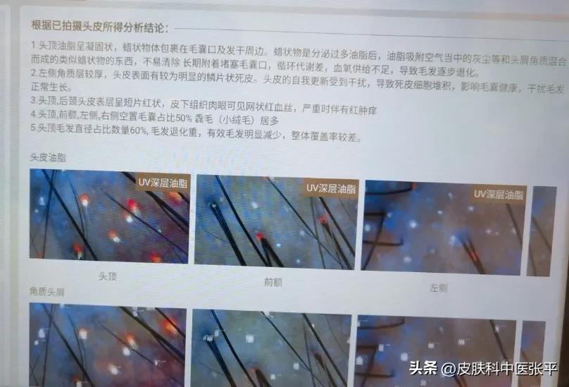 脱发，出现3种症状，说明肾已经受损了