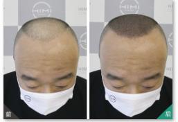男性！请慎重考虑单独使用米诺地尔