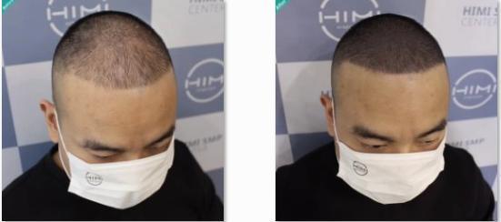 男性！请慎重考虑单独使用米诺地尔