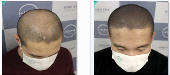 男性！请慎重考虑单独使用米诺地尔