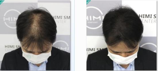 男性！请慎重考虑单独使用米诺地尔