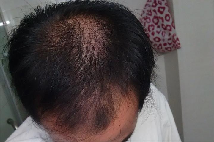米诺地尔使用十年是什么样的经历？很难想象