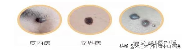 【爱美•科普】“痣”，绝对不可以轻视