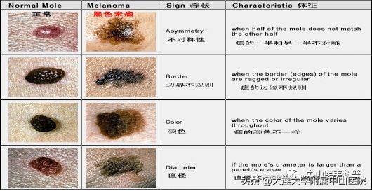 【爱美•科普】“痣”，绝对不可以轻视