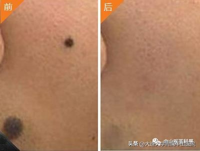 【爱美•科普】“痣”，绝对不可以轻视