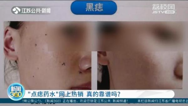 点痣药水热卖！专家提醒：或有癌变风险
