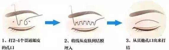 济南海峡整形科普：双眼皮做完后会消失吗？