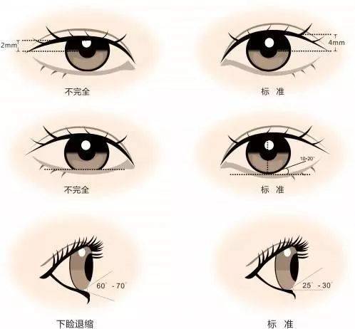 济南海峡整形科普：双眼皮做完后会消失吗？