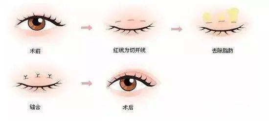 济南海峡整形科普：双眼皮做完后会消失吗？