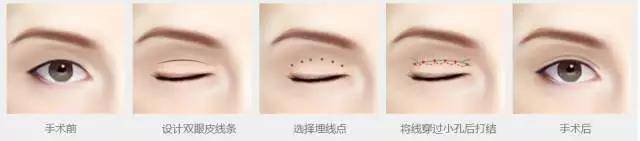 同一天做完双眼皮，为什么我恢复的比她慢？