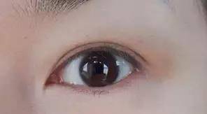 同一天做完双眼皮，为什么我恢复的比她慢？