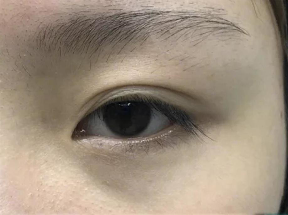 双眼皮术后眼睛上全是“皱纹”？不注意这3点当心毁眼睛