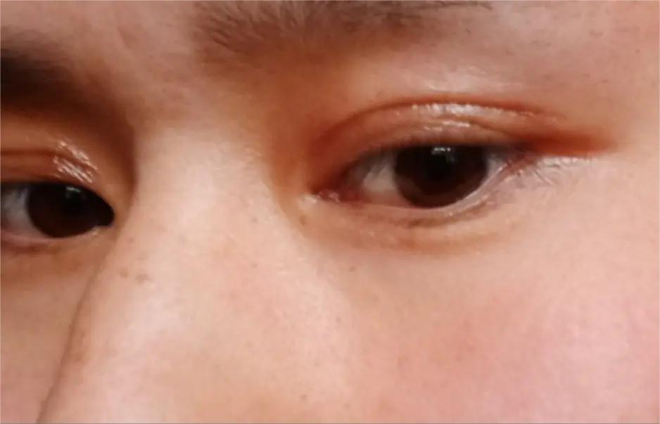 双眼皮术后眼睛上全是“皱纹”？不注意这3点当心毁眼睛