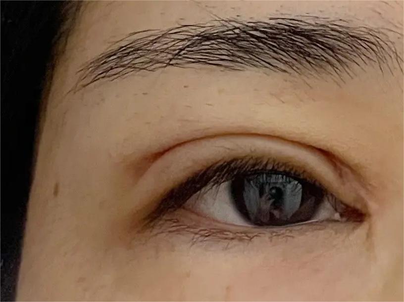 双眼皮术后眼睛上全是“皱纹”？不注意这3点当心毁眼睛