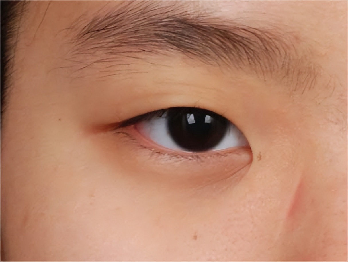 双眼皮术后眼睛上全是“皱纹”？不注意这3点当心毁眼睛