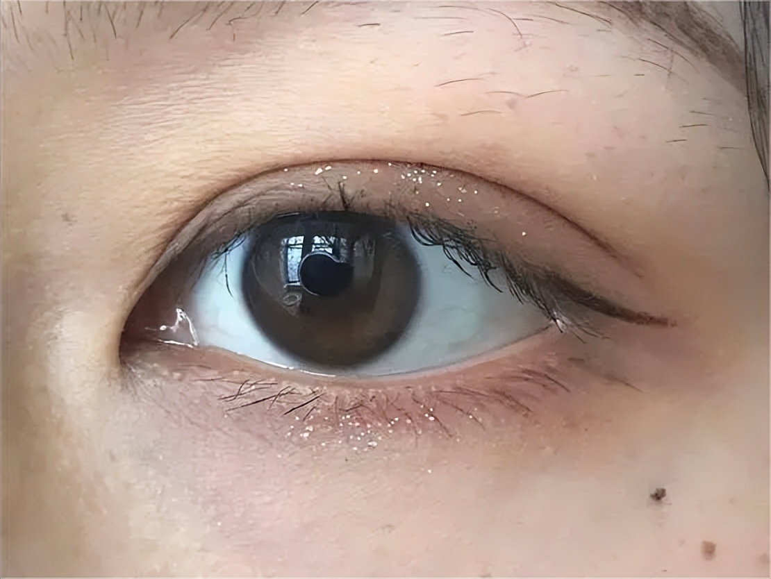 双眼皮术后眼睛上全是“皱纹”？不注意这3点当心毁眼睛