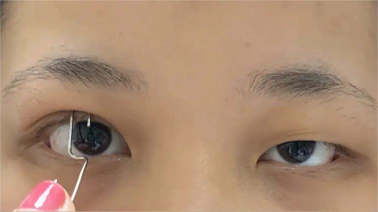 双眼皮术后眼睛上全是“皱纹”？不注意这3点当心毁眼睛