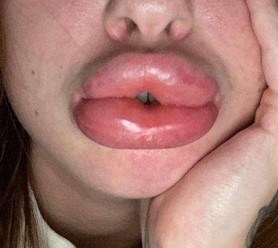 辣眼睛！女子图便宜做廉价丰唇手术，结果双唇如同腊肠，红肿发亮