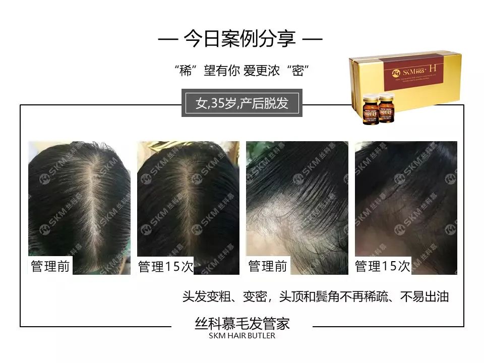 丝科慕毛发营养液专业版H