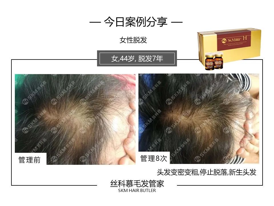 丝科慕毛发营养液专业版H