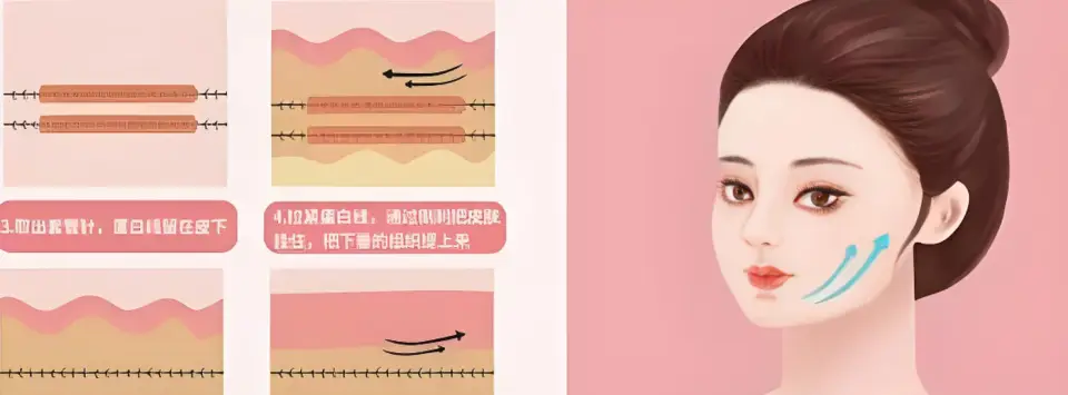 最全解析|线雕面部提升维持多久，线雕能维持多长时间？