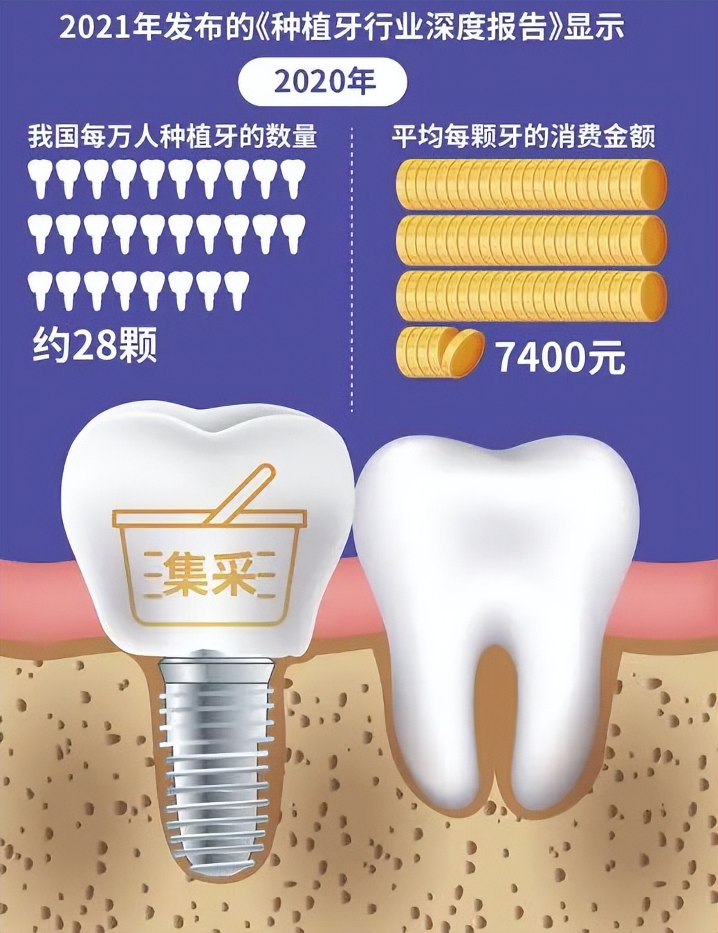 4月20日起！种植牙收费启动综合治理，种牙能省多少钱？
