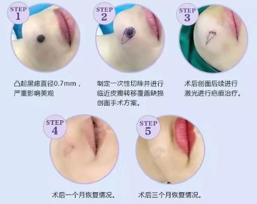 痣千万不要随便点，除了影响美观还有很大的潜在危险！