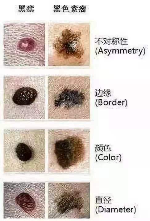 痣千万不要随便点，除了影响美观还有很大的潜在危险！